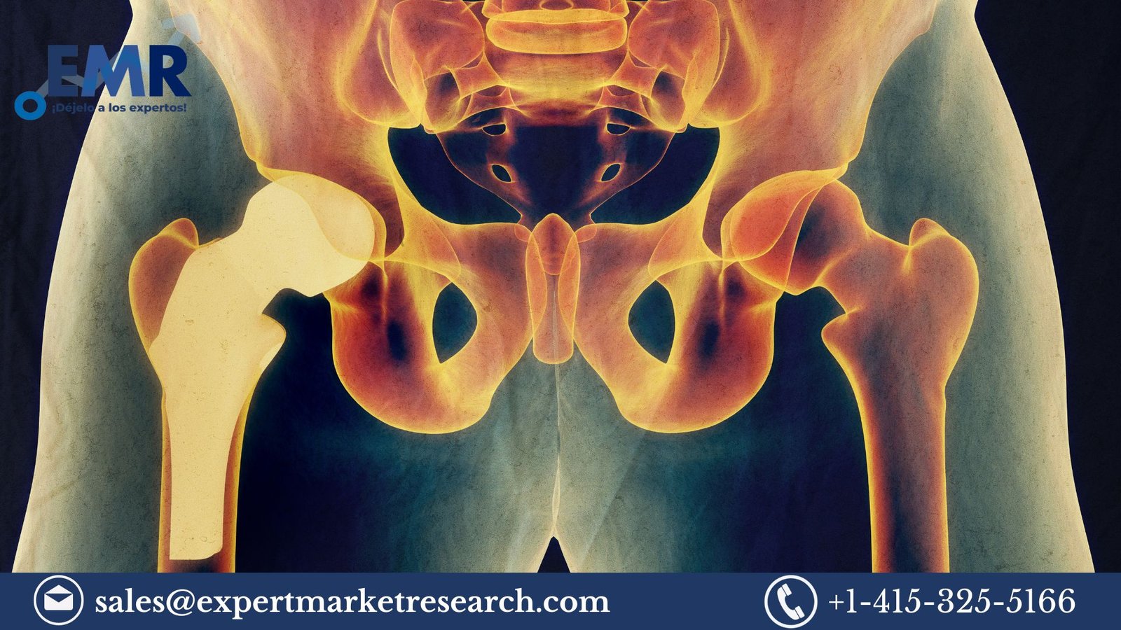 Hip Replacement Implants Market