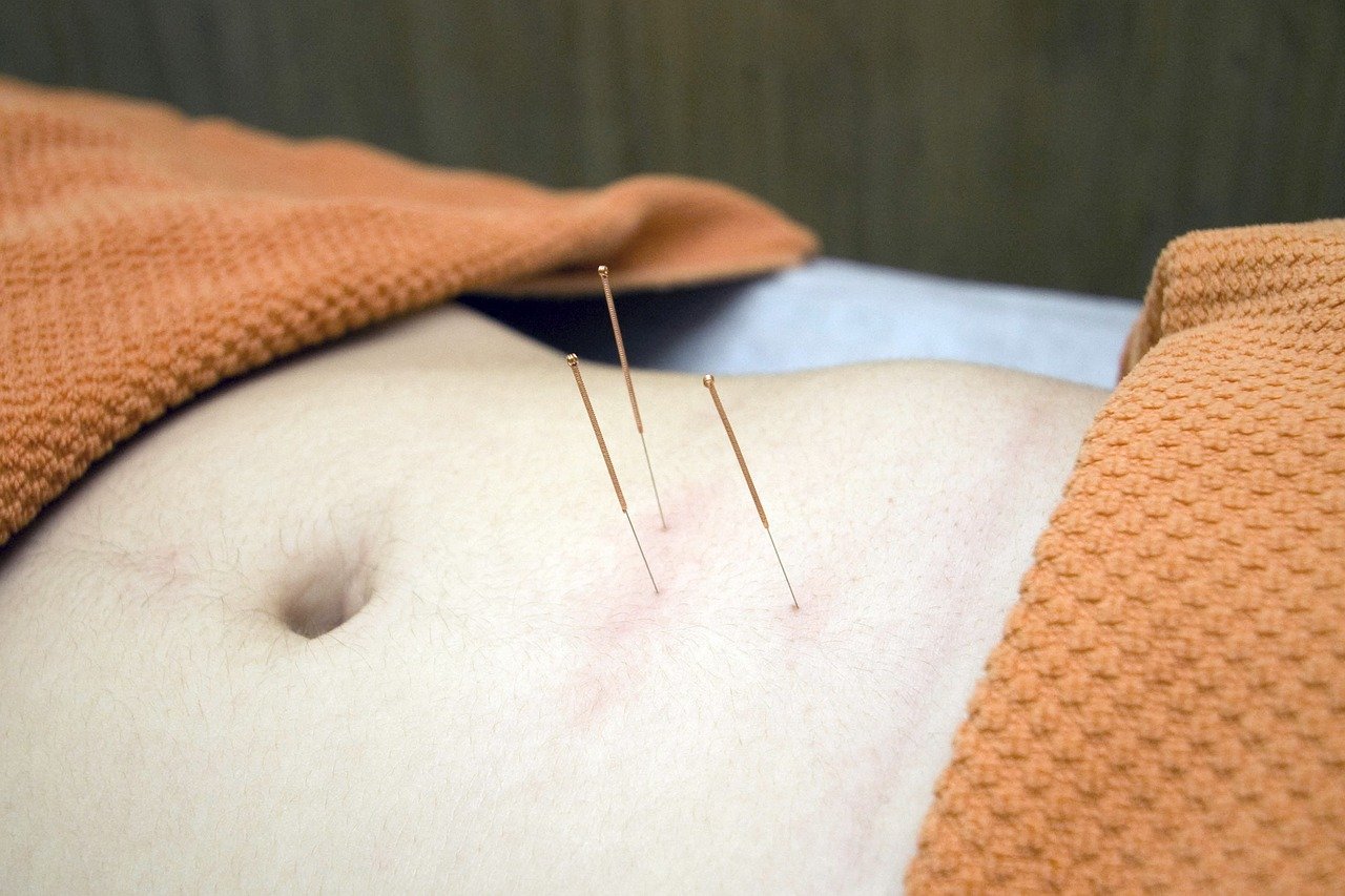 Exploring the Benefits of Kildare Acupuncture Clinic