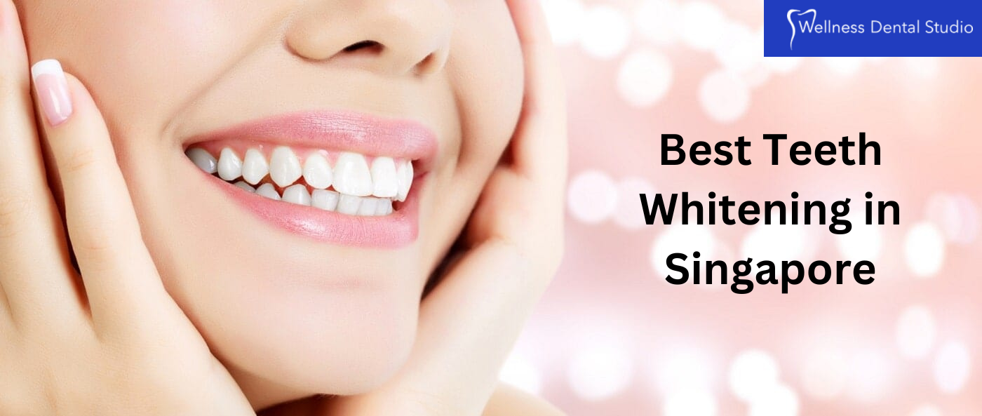 Best teeth whitening in Singapore