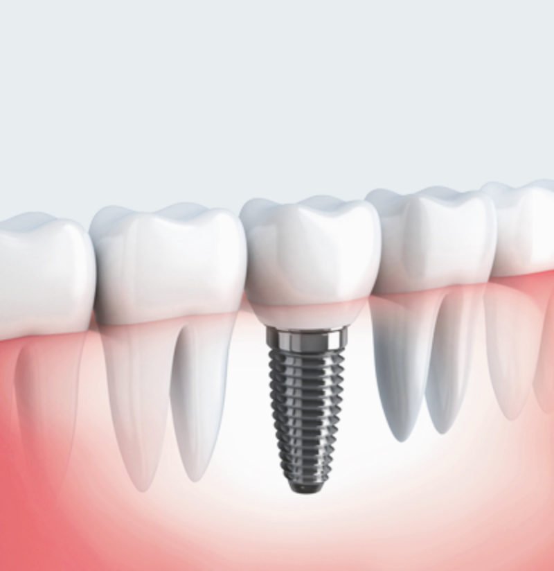 The Value of High-Quality Complete Dental Implant