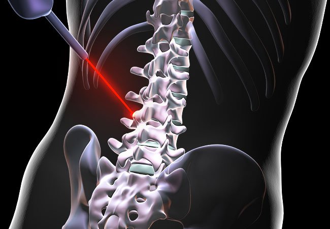 <strong>Laser Spine Surgery: Benefits and Drawbacks</strong>