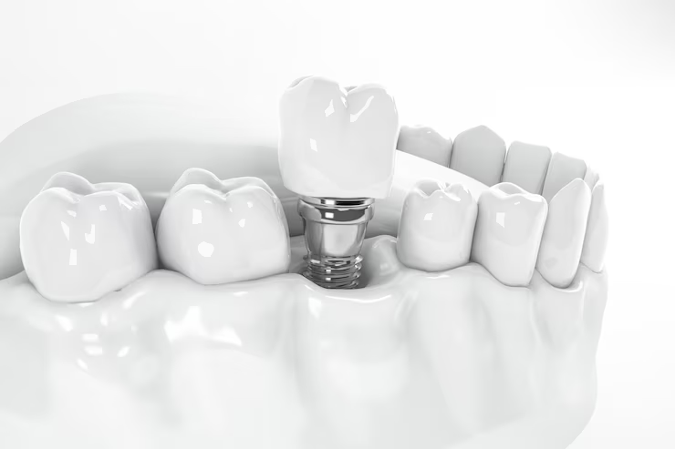 Dental Implants in Gulfport, MS