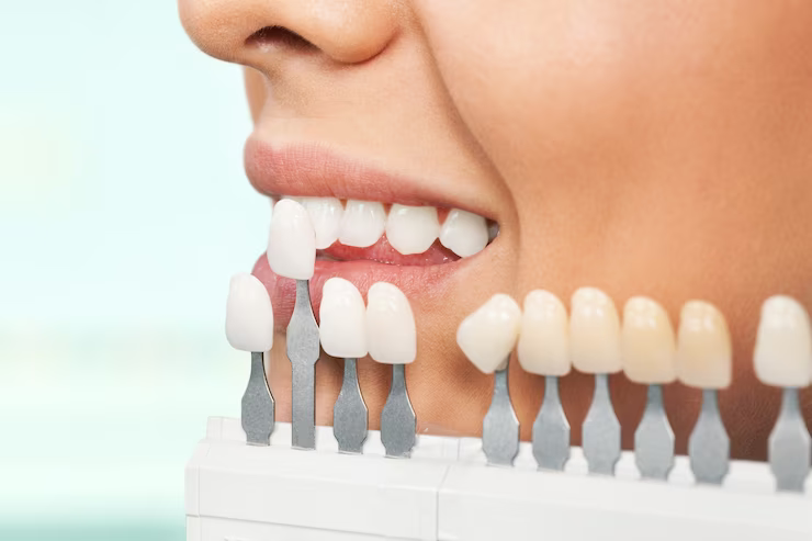 Dental Veneers and Dental Bonding