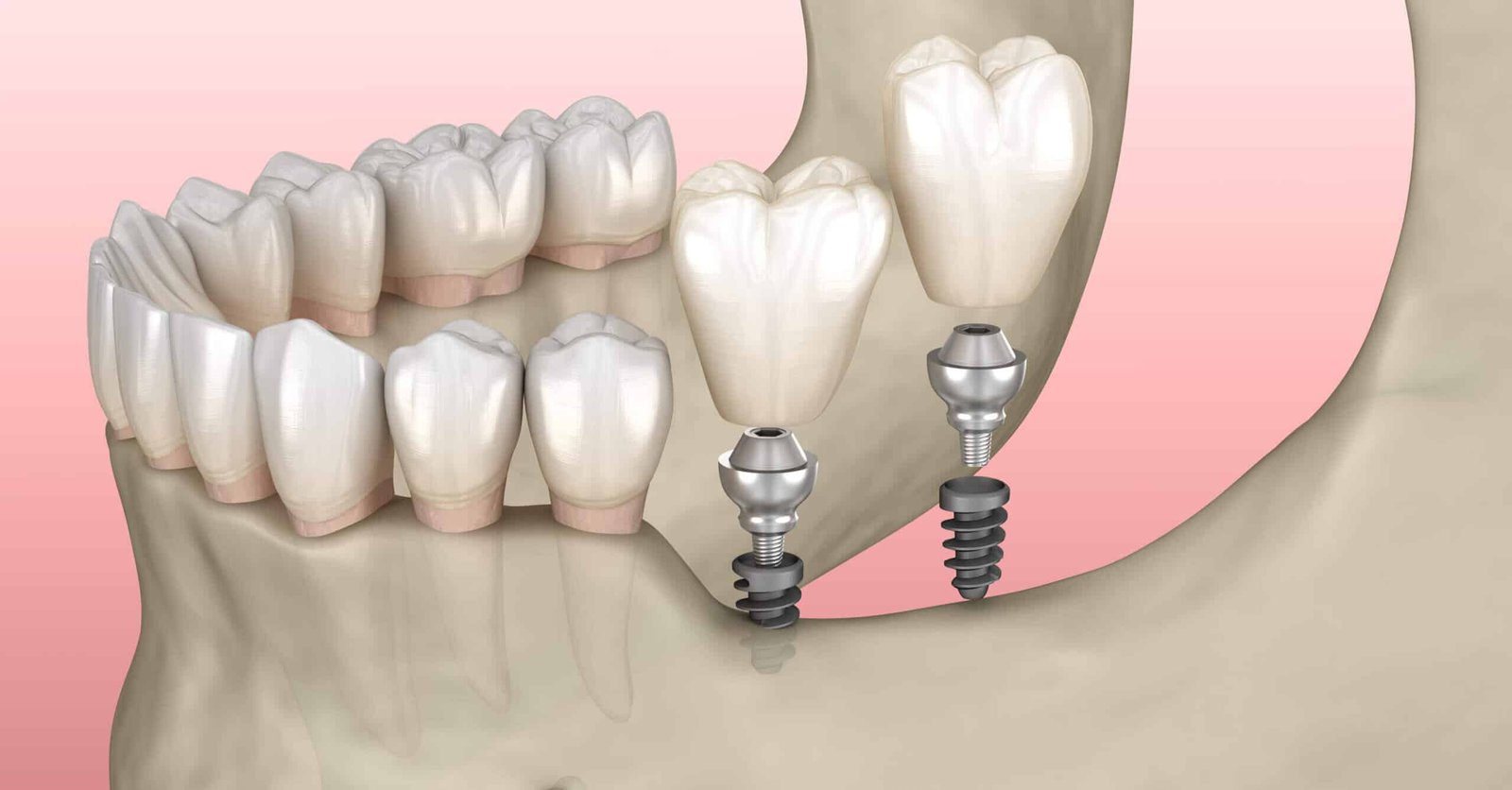 dental implant dentist near me in Houston Heights