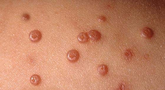 Introduction to Molluscum Contagiosum: What is it and How is it Spread?