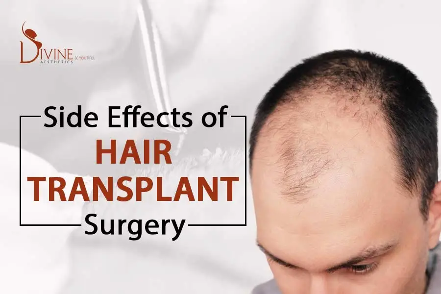 What Are the Side Effect of Hair Transplant?