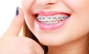 How To Find Cost-Effective Orthodontic Care