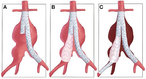 Ileac Stent Albuquerque