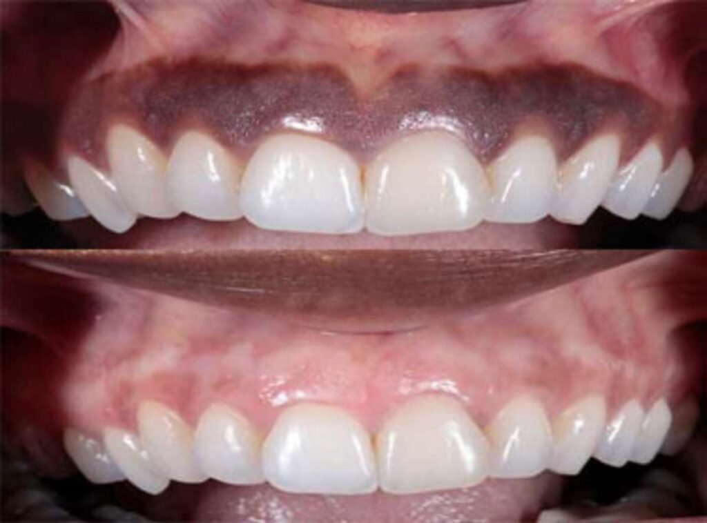 Dark Gums