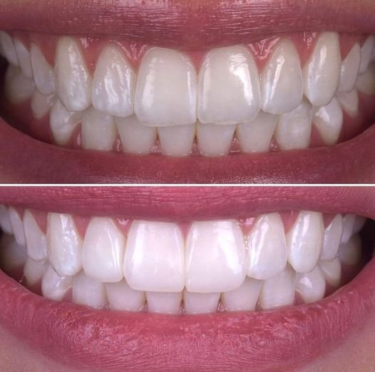 teeth whitening madeley