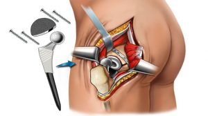 Is Hip Replacement Surgery Beneficial In India?