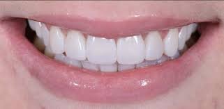 best teeth bonding broxburn