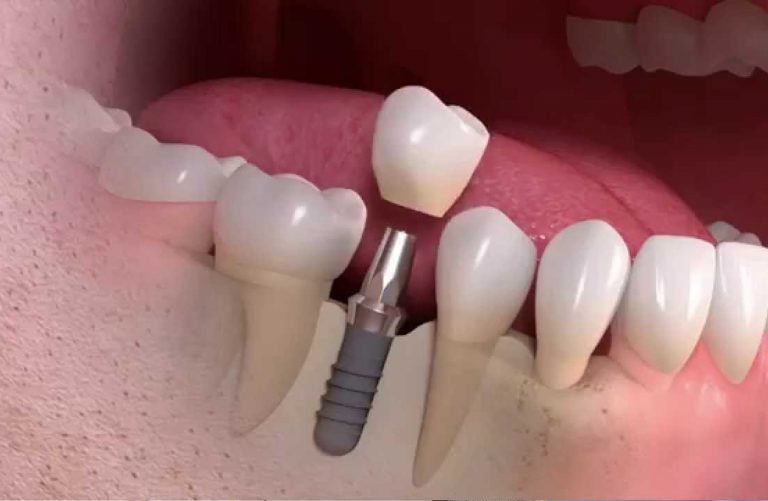 Dental Implants in Aberdeen