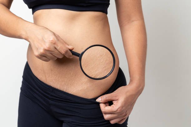 What are the methods to treat liposuction scars?