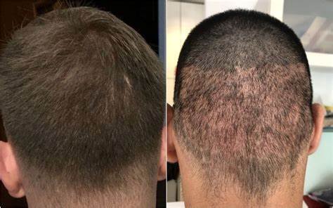 From Thinning to Thriving: The Benefits of FUE Hair Transplants