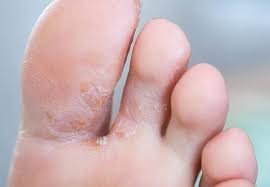 The Benefits of Using Antifungal Creams for Athlete's Foot and Ringworm